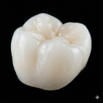 Estética Final - Corona de Zirconia